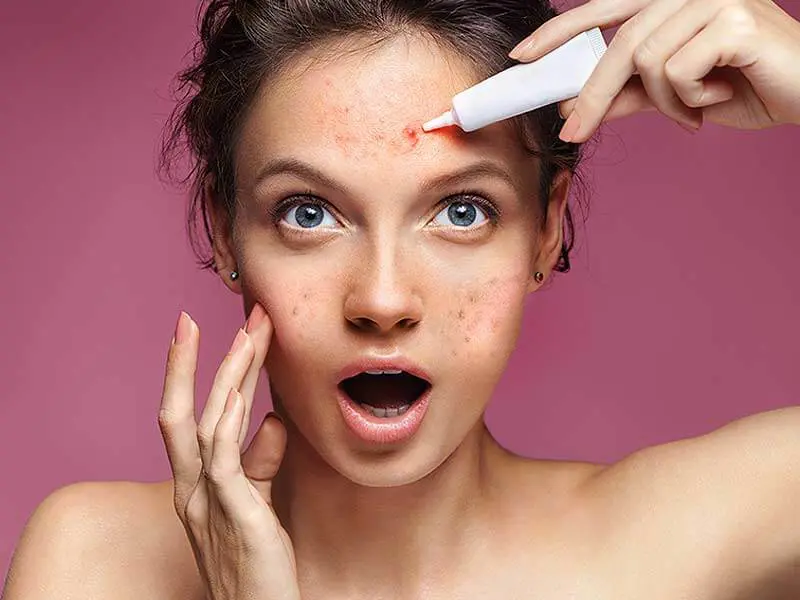 Akne Nedir? Sivilce oluşumunun nedenleri ve tedavileri nelerdir? görseli