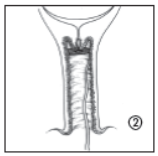 PROPESS OVUL 10 MG 1 OVUL görseli 3